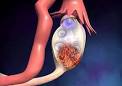 Les tumeurs de l ovaire : cancers et kystes de l ovaire - Symptmes