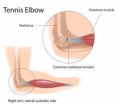 Image result for tendonitis